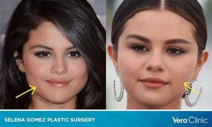 Selena Gomez & Plastic Surgery Experts Claim She Had Work Done
