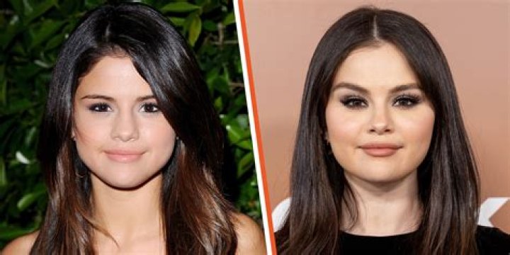 Selena Gomez Plastic Surgery or Lupus? Why Fans are Wrong