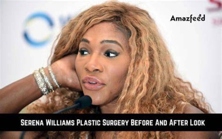 Serena Williams Plastic Surgery Before & After 2022