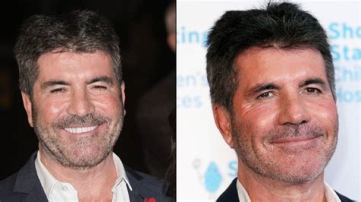 Simon Cowell Revealed the Horrifying Reason He Quit Botox