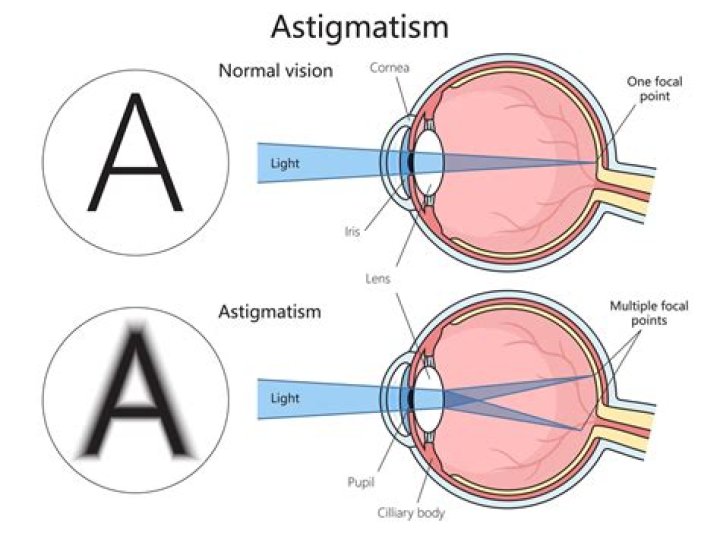 Stigmatism and Astigmatism Understanding the Differences and Similari