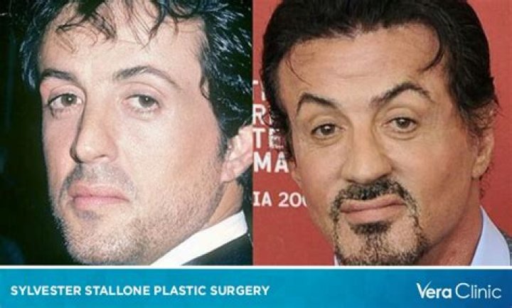 Sylvester Stallone Plastic Surgery Before And After Pictures My XXX