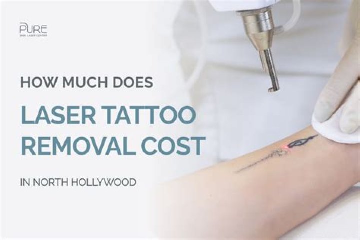 Tattoo Removal Treatment Laser Free Tattoo Ideas