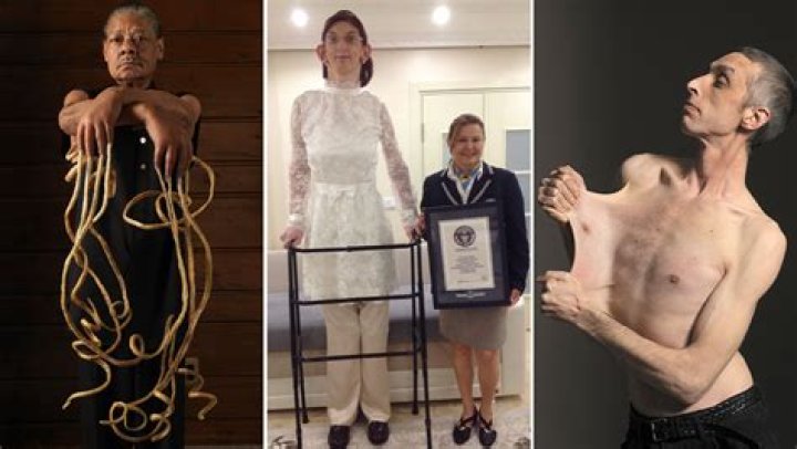 The skinniest Person Ever World Skinniest People You should Know