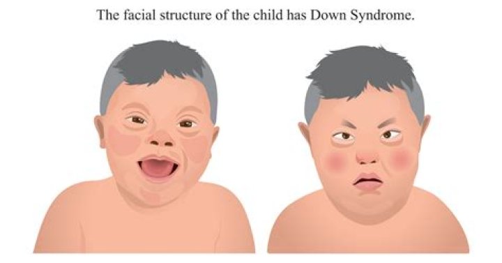 Theo Von Down Syndrome Illness And Health Update 2023