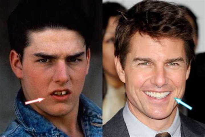 Tom Cruise Plastic Surgery Teeth, Nose Job, Hair, Facelift