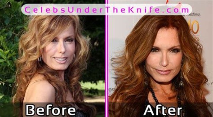 Tracey Bregman Plastic Surgery, Illness, Bio, Wiki, Age, Career