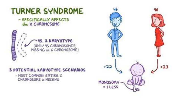 Turner Syndrome Causes and Symptoms