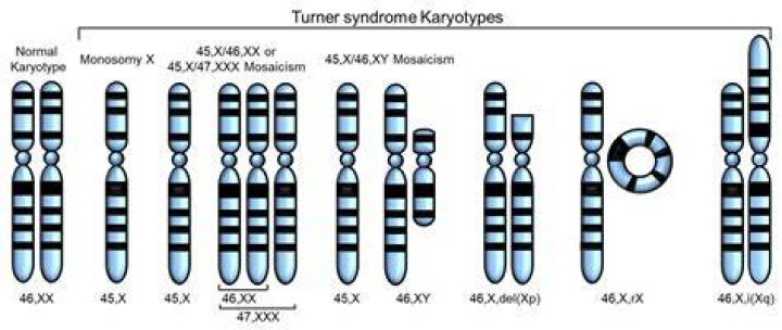 Turner Syndrome Q & A (2nd Edition) YouTube