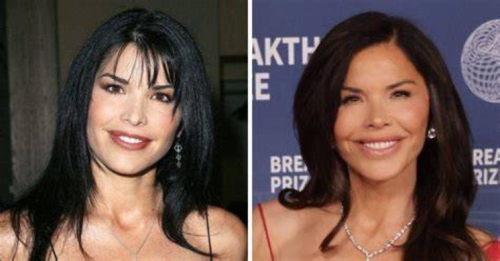 Unveiling Sherlyn Chopra's Plastic Surgery Evolution: Before And After Insights