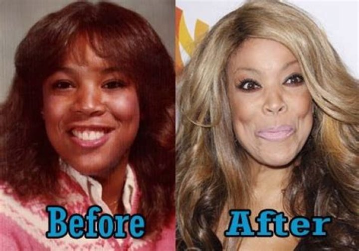 Wendy Williams Plastic Surgery Nose Job, Breast Implants, Facelift