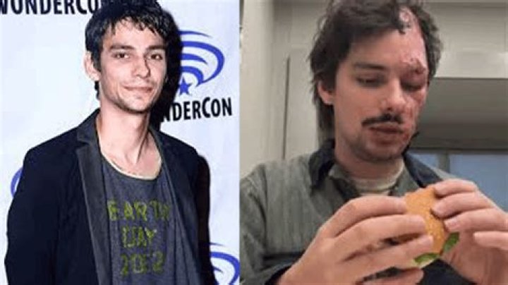 What Happened To Devon Bostick Face? Before Plastic Surgery