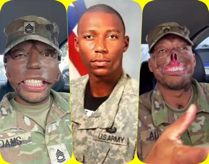What Happened To Soldier Randy Adams' Face?