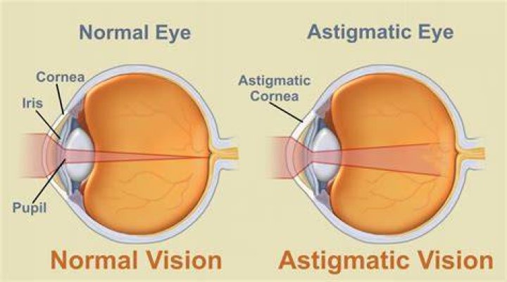 What Is Astigmatism? New Health Guide