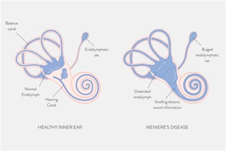 What is Meniere's disease? Hearing Link