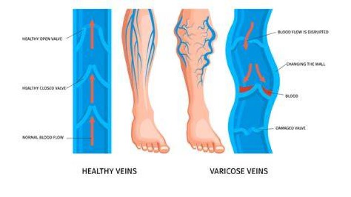 Why Do Veins Pop Out When Exercising, and Is That Good or Bad