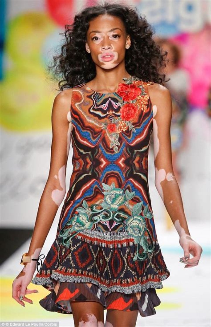 Winnie Harlow recalls bullying and abuse in essay about her vitiligo