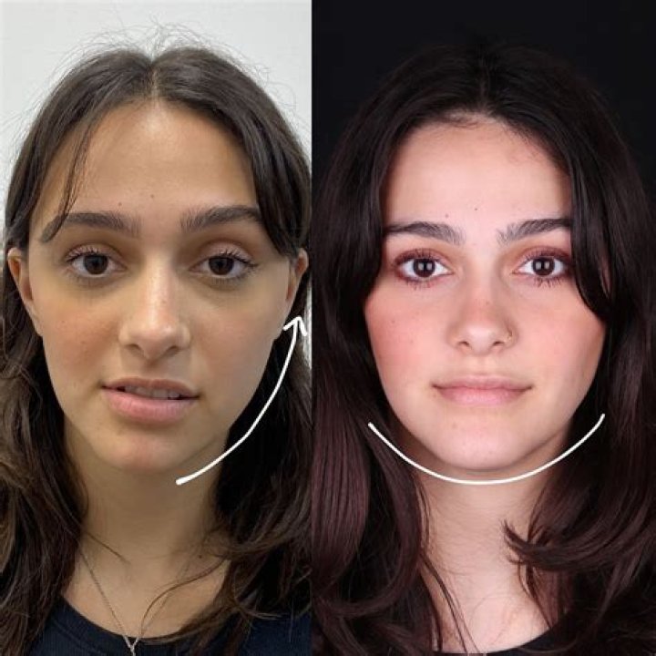 WTF! HazelE&rsquo;s New Surgery Will Blow Your Mind Global Grind
