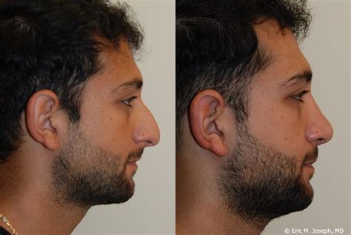 Zach Braff Nose Job Before And After