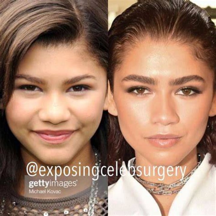 Zendaya Plastic Surgery Before and After Plastic Surgery Magazine