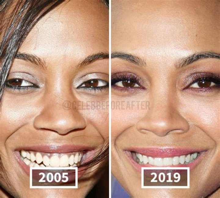Zoe Saldana Plastic Surgery Does She Use Botox?